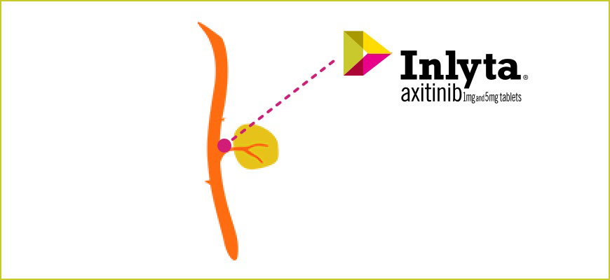 INLYTA® (axitinib) prevents new blood vessels from forming, it may help stop tumors from growing. See safety info