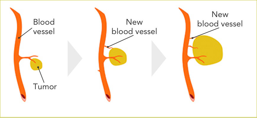 Cancer cells need a constant supply of oxygen and nutrients to spread. They get these from blood vessels